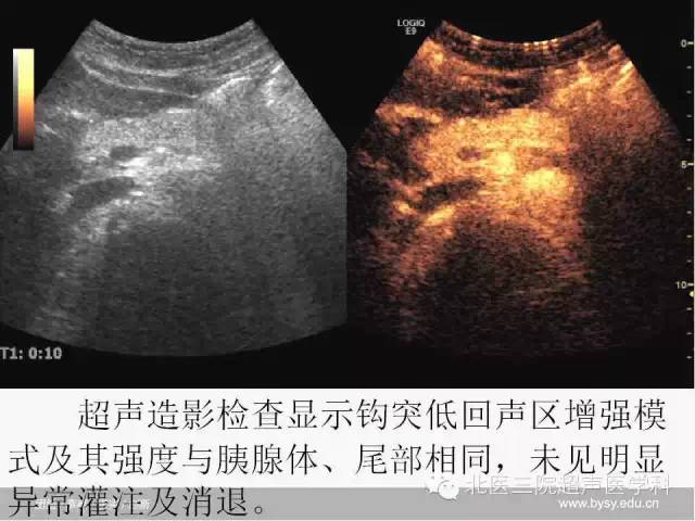 【PPT】胰腺常见解剖变异及影像学表现