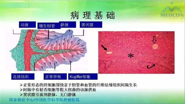 【PPT】肝脏局灶性结节增生（FNH）影像诊断及进展