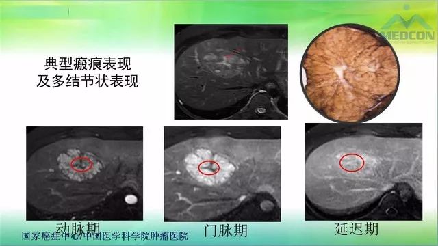 【PPT】肝脏局灶性结节增生（FNH）影像诊断及进展