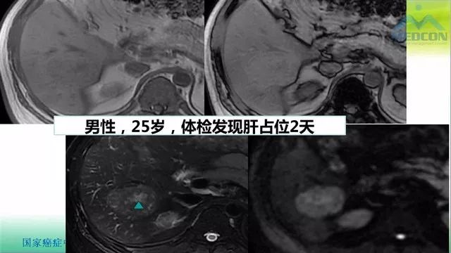 【PPT】肝脏局灶性结节增生（FNH）影像诊断及进展