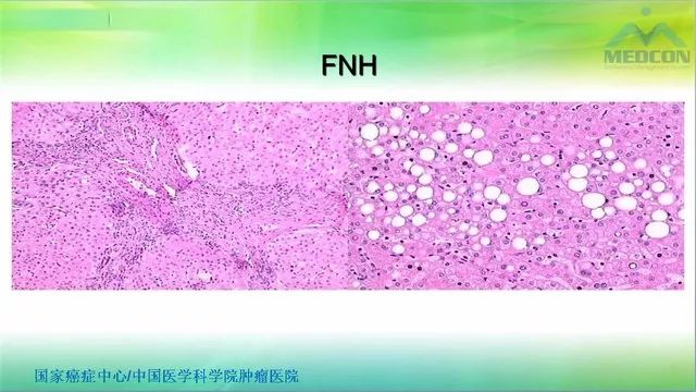 【PPT】肝脏局灶性结节增生（FNH）影像诊断及进展