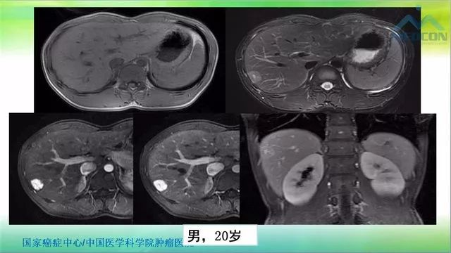 【PPT】肝脏局灶性结节增生（FNH）影像诊断及进展