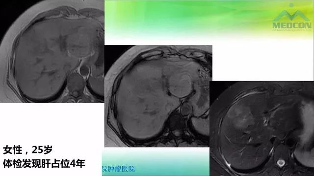 【PPT】肝脏局灶性结节增生（FNH）影像诊断及进展