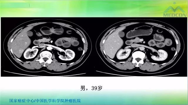 【PPT】肝脏局灶性结节增生（FNH）影像诊断及进展