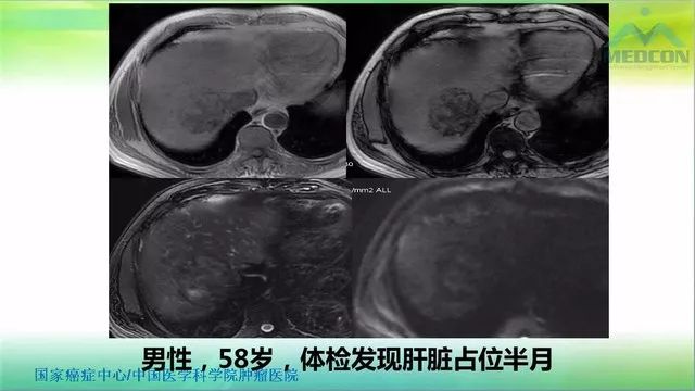 【PPT】肝脏局灶性结节增生（FNH）影像诊断及进展