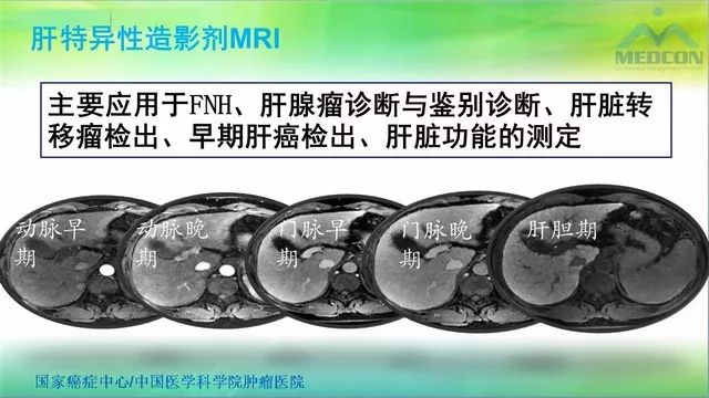 【PPT】肝脏局灶性结节增生（FNH）影像诊断及进展