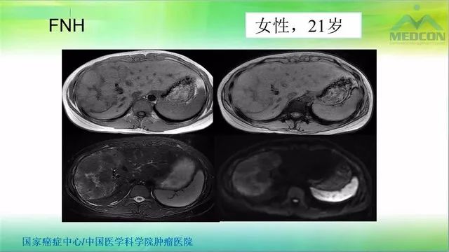 【PPT】肝脏局灶性结节增生（FNH）影像诊断及进展