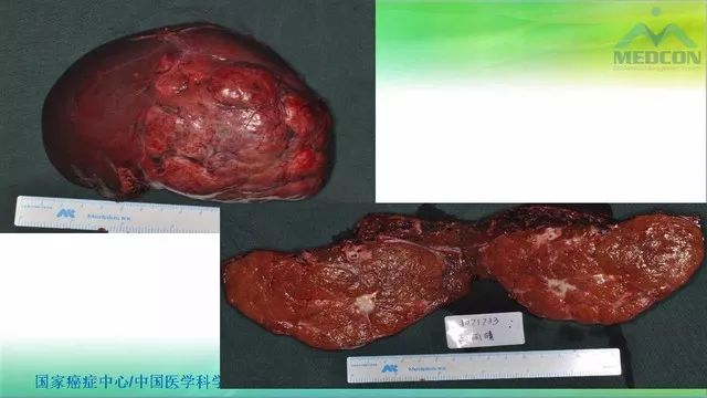 【PPT】肝脏局灶性结节增生（FNH）影像诊断及进展