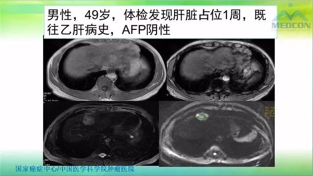 【PPT】肝脏局灶性结节增生（FNH）影像诊断及进展