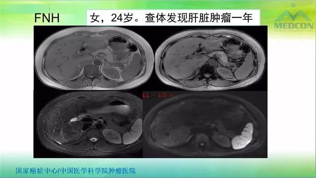 【PPT】肝脏局灶性结节增生（FNH）影像诊断及进展