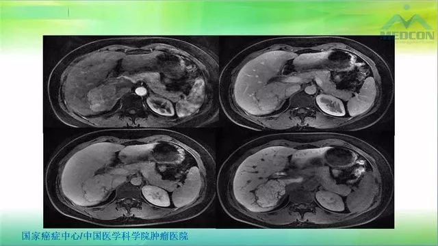 【PPT】肝脏局灶性结节增生（FNH）影像诊断及进展