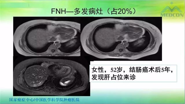 【PPT】肝脏局灶性结节增生（FNH）影像诊断及进展