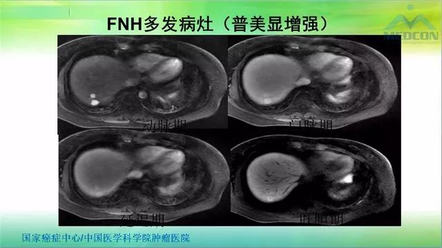 【PPT】肝脏局灶性结节增生（FNH）影像诊断及进展