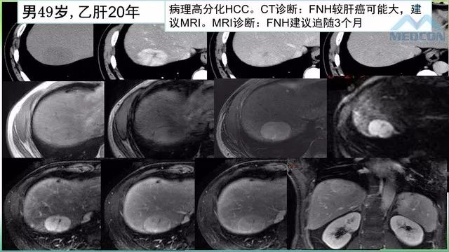 【PPT】肝脏局灶性结节增生（FNH）影像诊断及进展