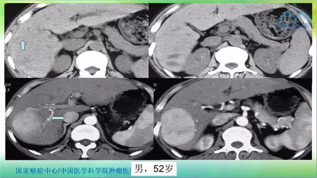 【PPT】肝脏局灶性结节增生（FNH）影像诊断及进展