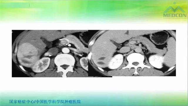 【PPT】肝脏局灶性结节增生（FNH）影像诊断及进展