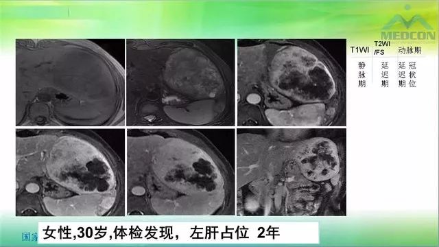【PPT】肝脏局灶性结节增生（FNH）影像诊断及进展