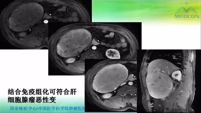 【PPT】肝脏局灶性结节增生（FNH）影像诊断及进展