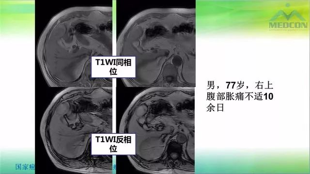 【PPT】肝脏局灶性结节增生（FNH）影像诊断及进展