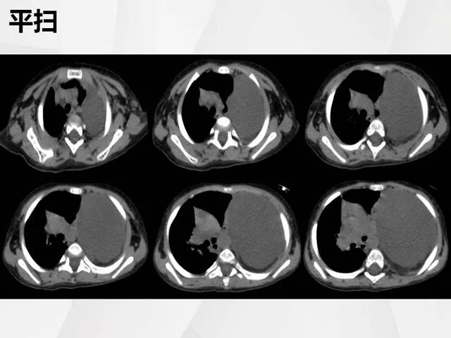 【病例】胸腔脂肪母细胞瘤1例CT 【病例】胸腔脂肪母细胞瘤1例CT