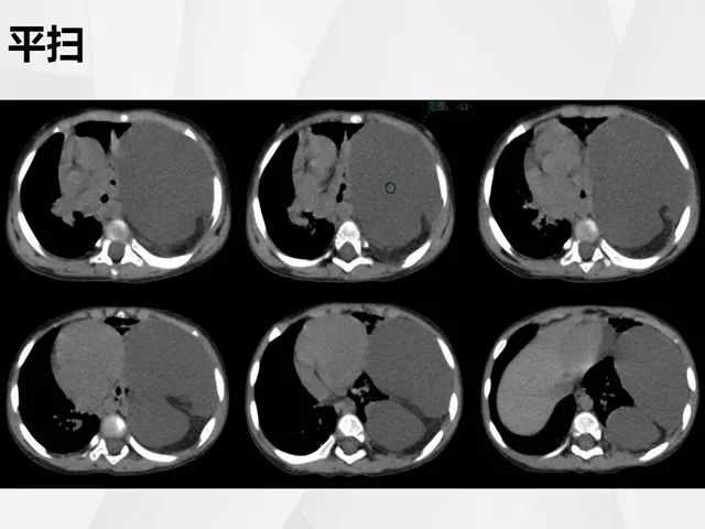 【病例】胸腔脂肪母细胞瘤1例CT 【病例】胸腔脂肪母细胞瘤1例CT