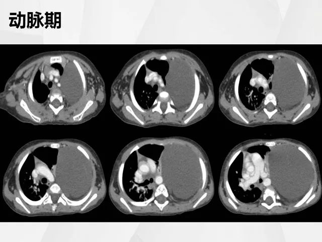 【病例】胸腔脂肪母细胞瘤1例CT 【病例】胸腔脂肪母细胞瘤1例CT
