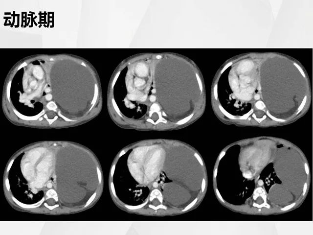【病例】胸腔脂肪母细胞瘤1例CT 【病例】胸腔脂肪母细胞瘤1例CT