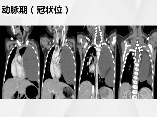 【病例】胸腔脂肪母细胞瘤1例CT 【病例】胸腔脂肪母细胞瘤1例CT