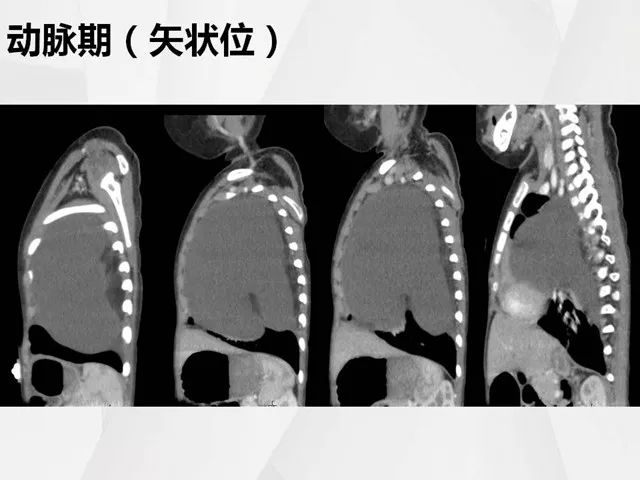 【病例】胸腔脂肪母细胞瘤1例CT 【病例】胸腔脂肪母细胞瘤1例CT