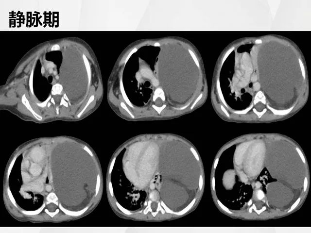 【病例】胸腔脂肪母细胞瘤1例CT 【病例】胸腔脂肪母细胞瘤1例CT