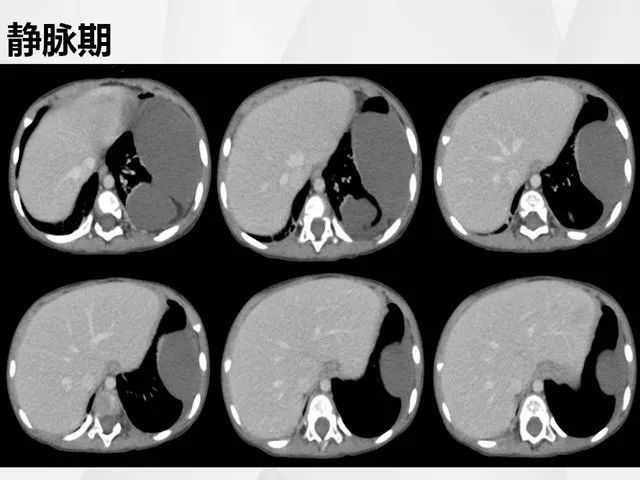 【病例】胸腔脂肪母细胞瘤1例CT 【病例】胸腔脂肪母细胞瘤1例CT