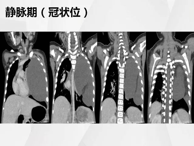 【病例】胸腔脂肪母细胞瘤1例CT 【病例】胸腔脂肪母细胞瘤1例CT