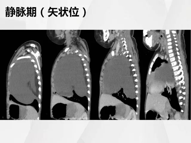 【病例】胸腔脂肪母细胞瘤1例CT 【病例】胸腔脂肪母细胞瘤1例CT