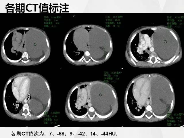 【病例】胸腔脂肪母细胞瘤1例CT 【病例】胸腔脂肪母细胞瘤1例CT