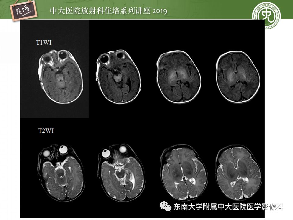 【PPT】小儿脑发育的MRI表现