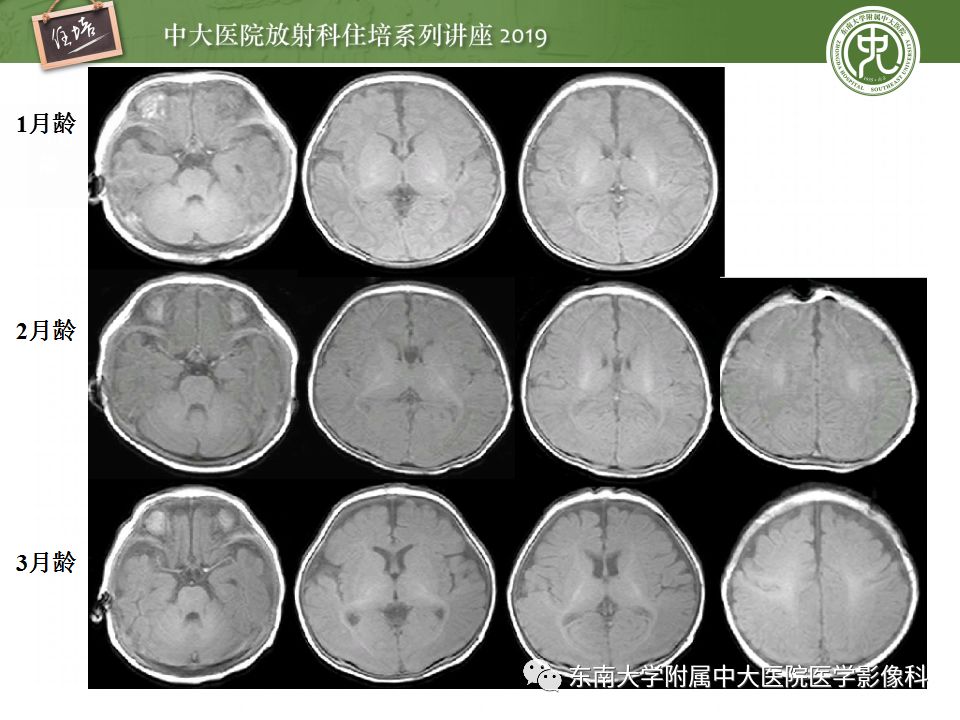 【PPT】小儿脑发育的MRI表现
