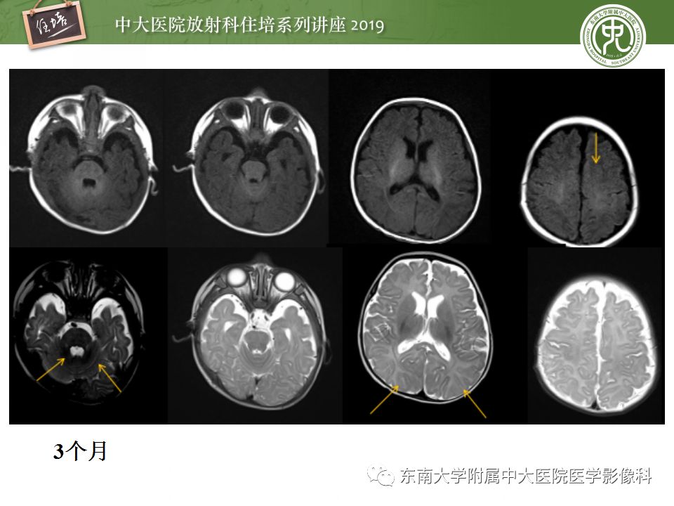 【PPT】小儿脑发育的MRI表现