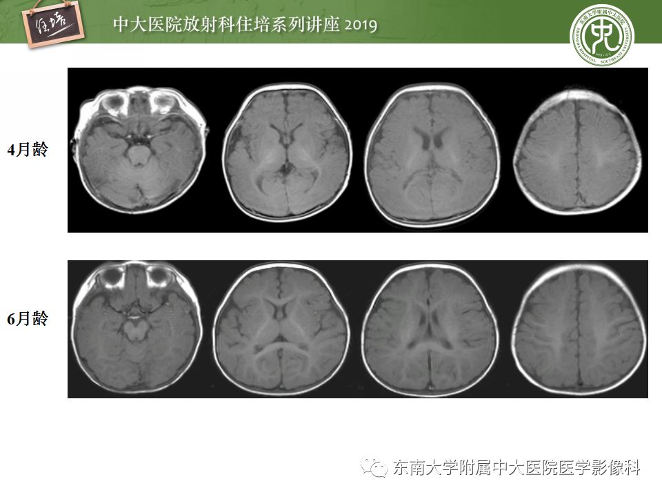 【PPT】小儿脑发育的MRI表现