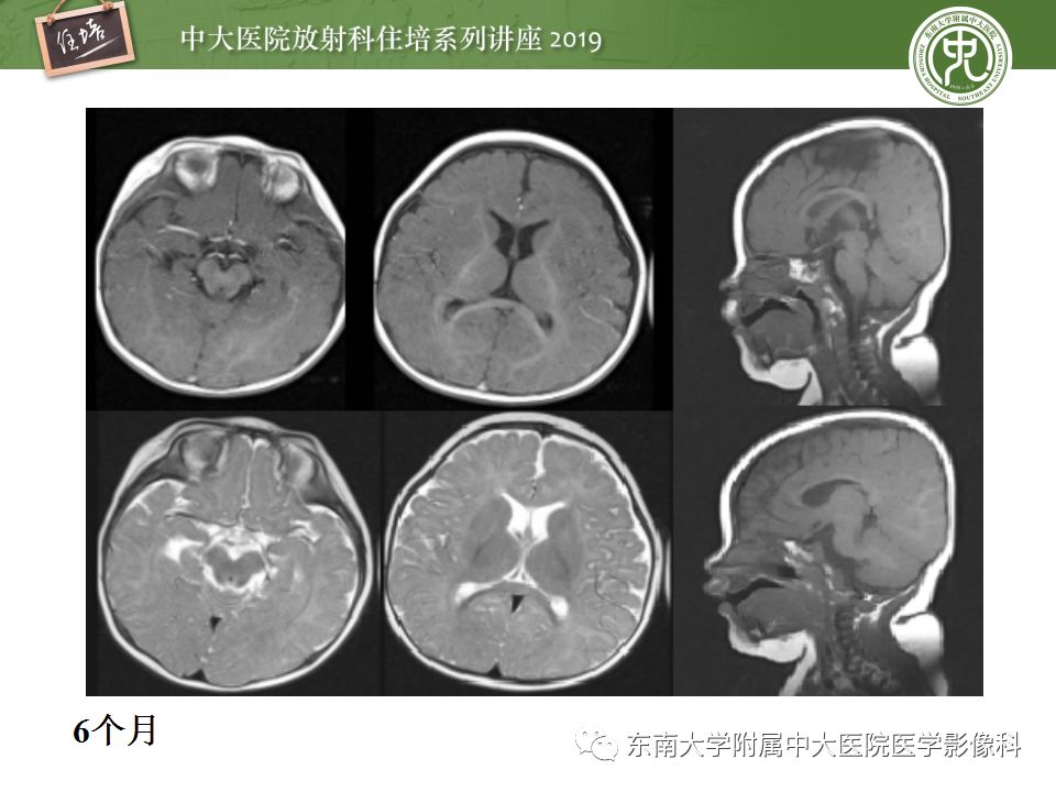 【PPT】小儿脑发育的MRI表现