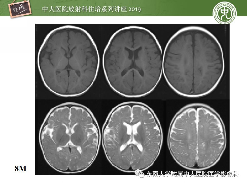 【PPT】小儿脑发育的MRI表现