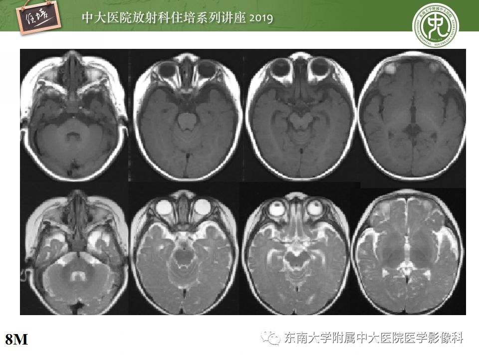 【PPT】小儿脑发育的MRI表现