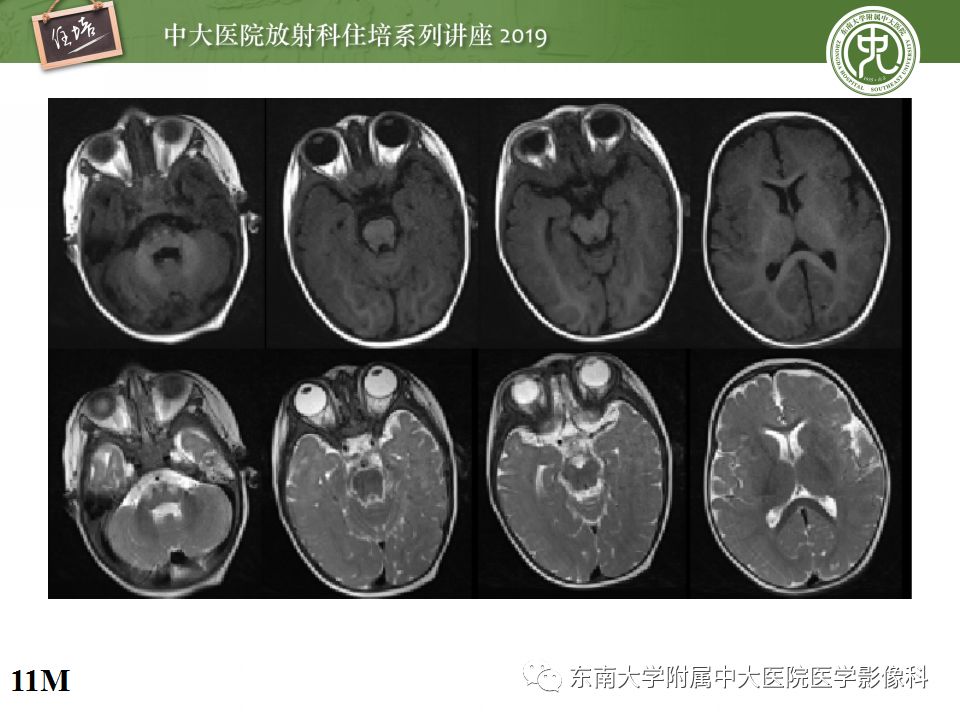 【PPT】小儿脑发育的MRI表现