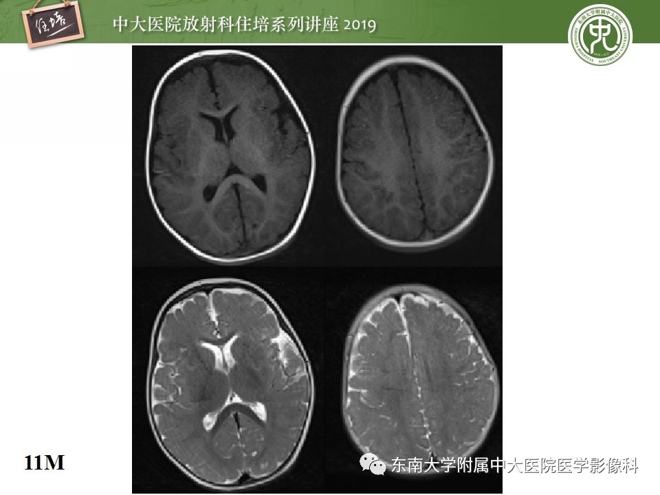 【PPT】小儿脑发育的MRI表现