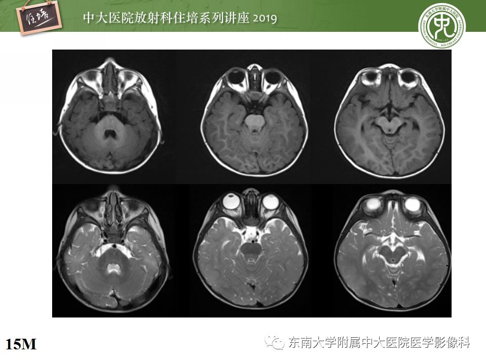 【PPT】小儿脑发育的MRI表现