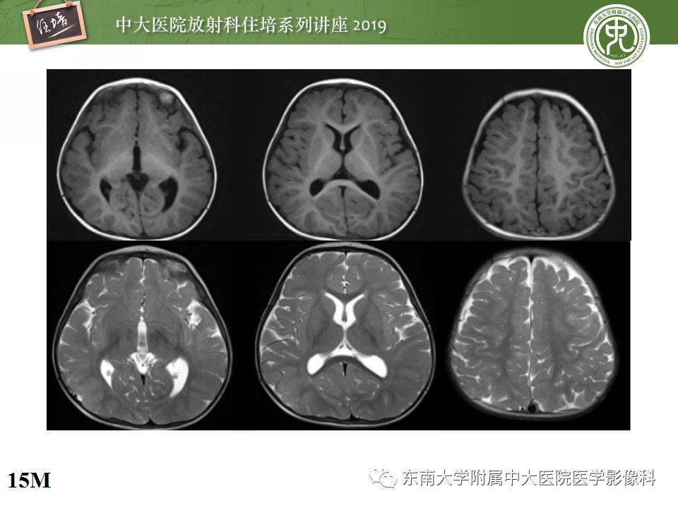 【PPT】小儿脑发育的MRI表现