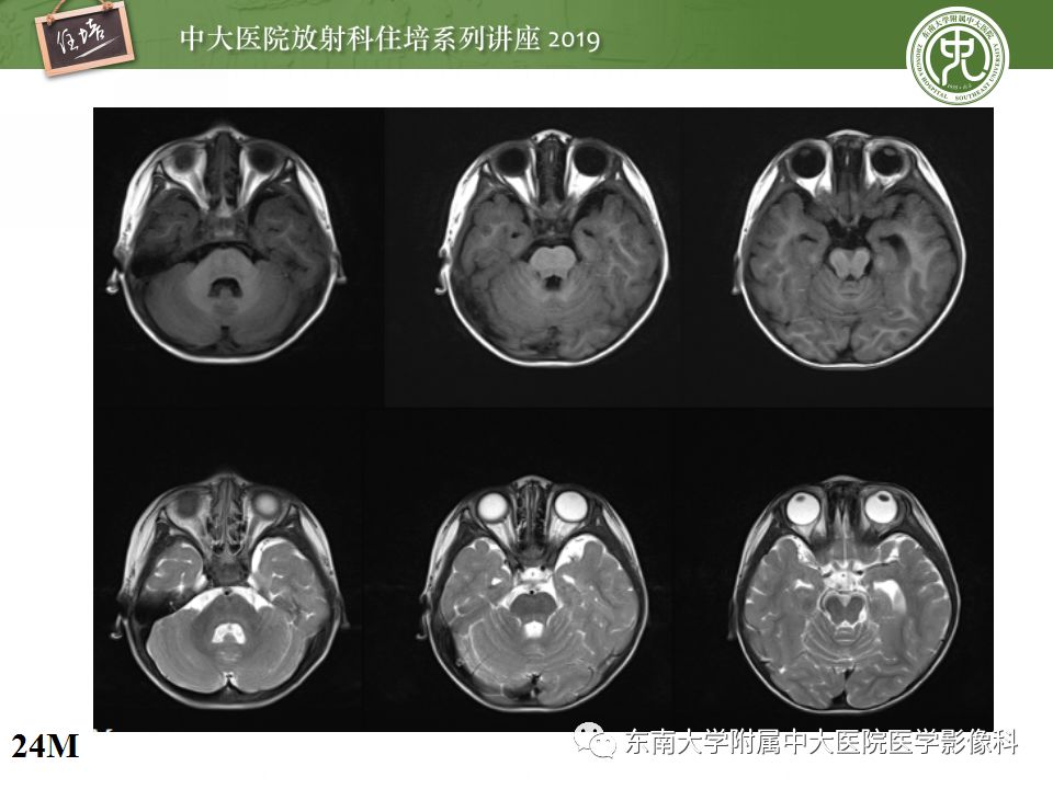 【PPT】小儿脑发育的MRI表现
