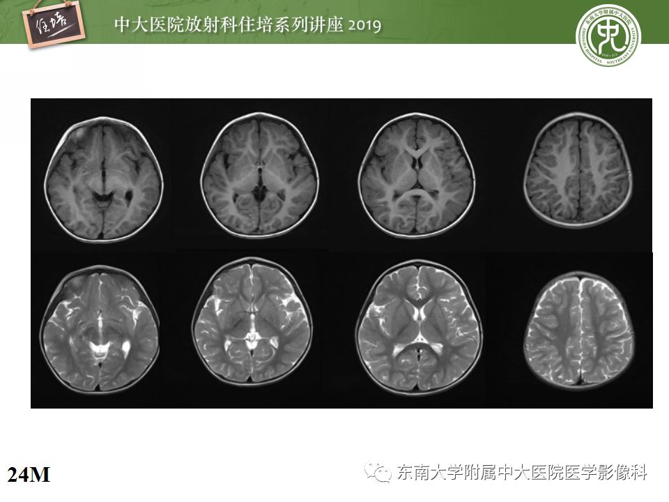 【PPT】小儿脑发育的MRI表现