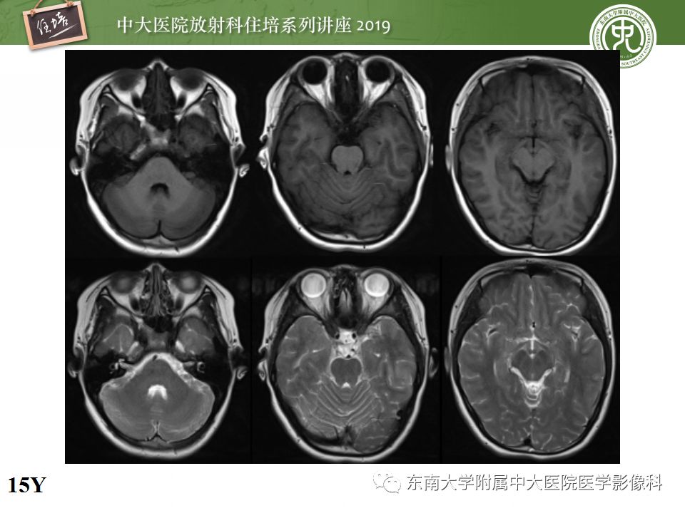 【PPT】小儿脑发育的MRI表现