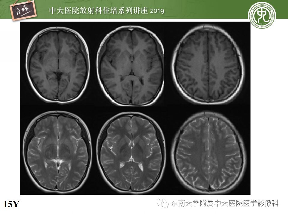 【PPT】小儿脑发育的MRI表现