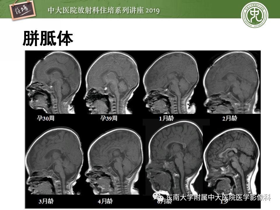 【PPT】小儿脑发育的MRI表现